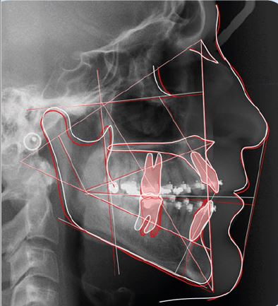 Owandy Ceph Analysis Orthodontic Software